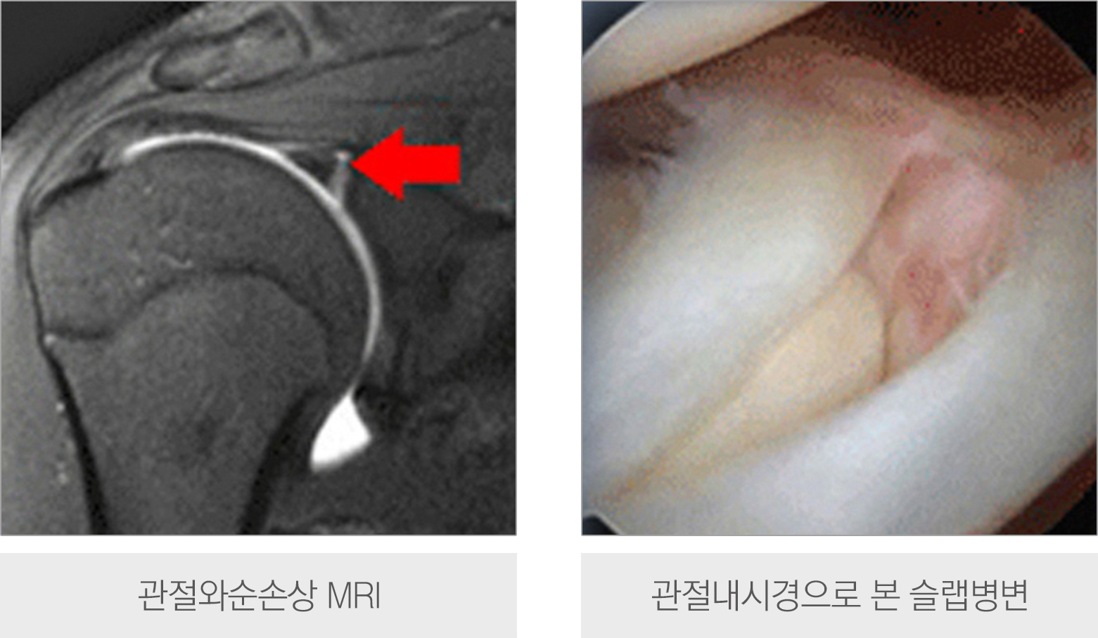 관절와순손상