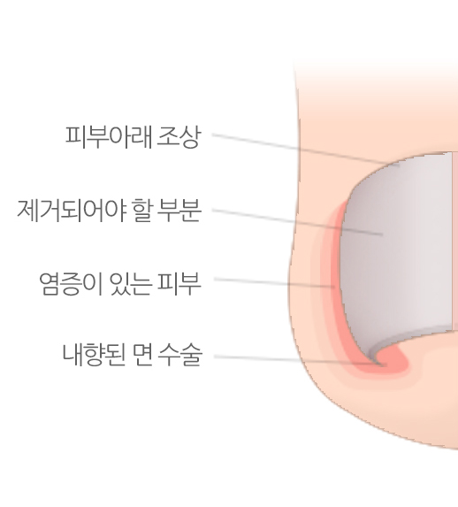 내향성발톱