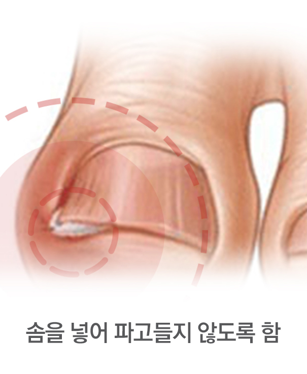 내향성발톱