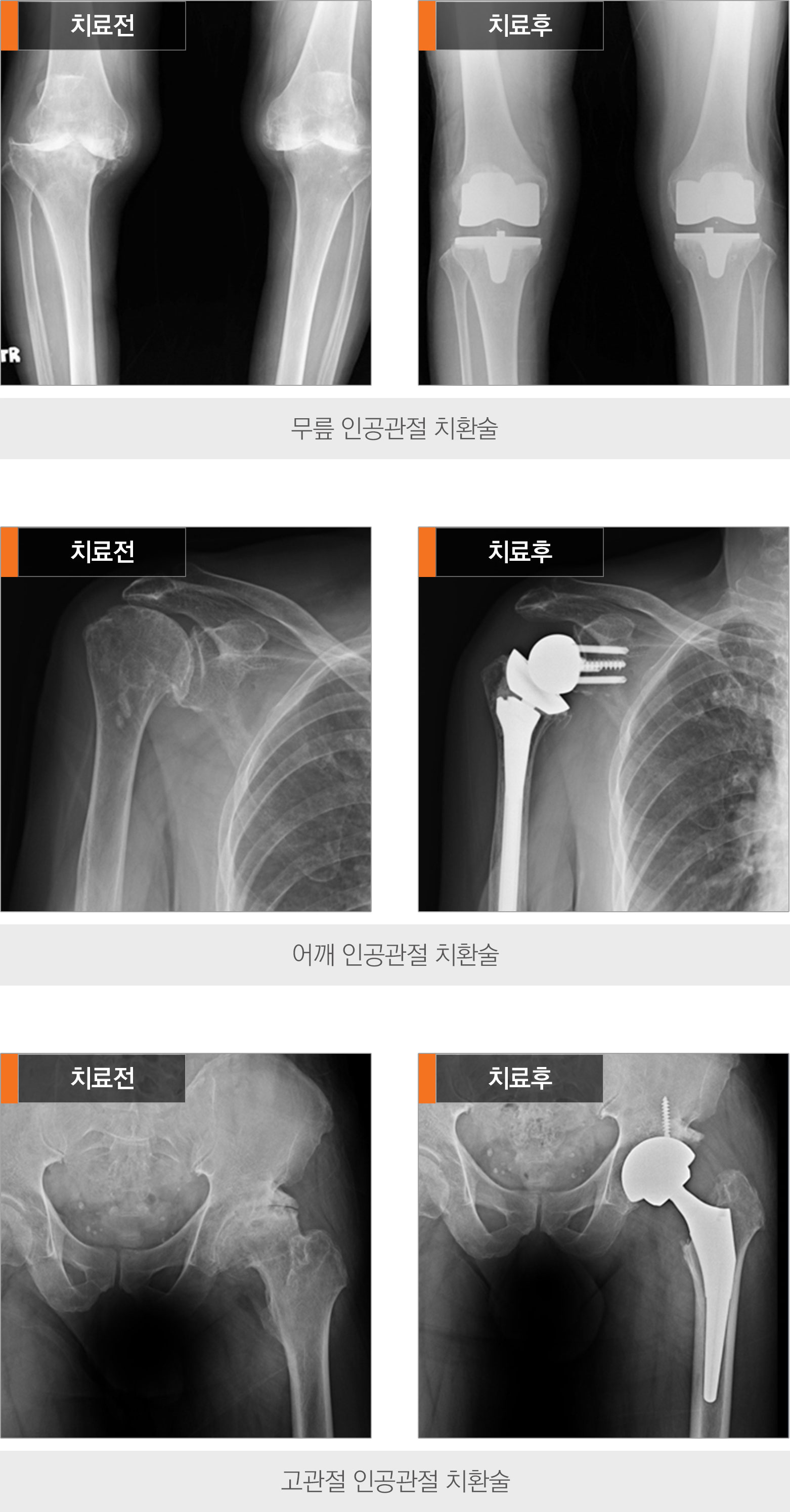 인공관절