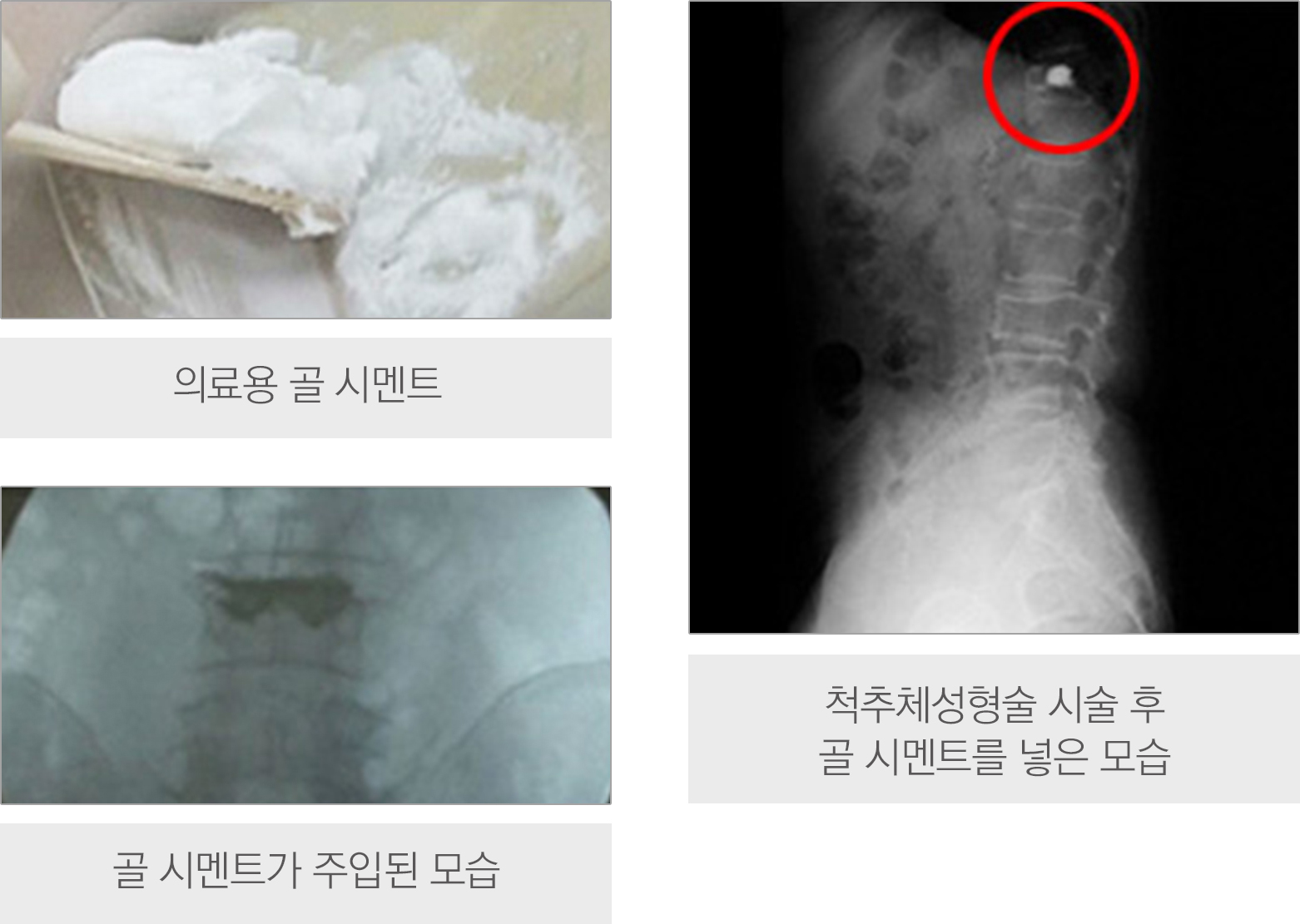 척추압박골절