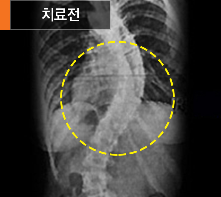 척추관협착증