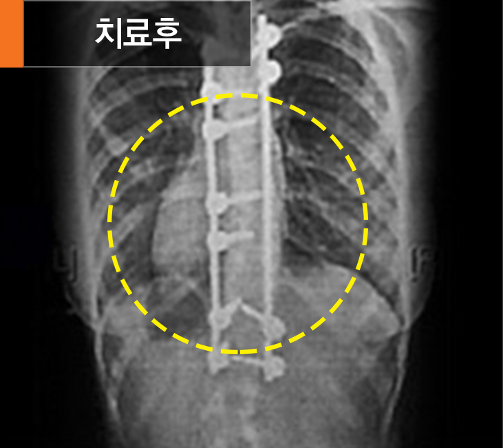 척추관협착증