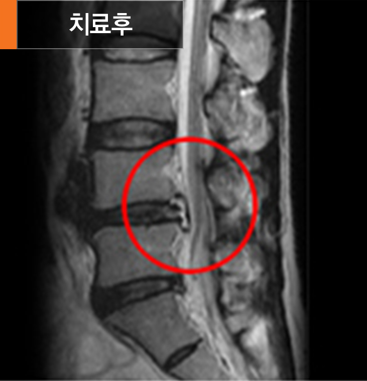 미세현미경일측성감압술