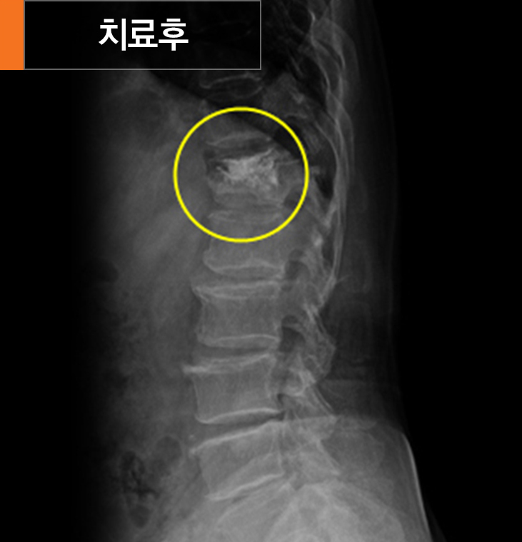 척추체성형술