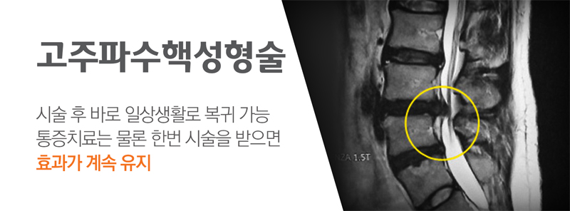 고주파수핵성형술