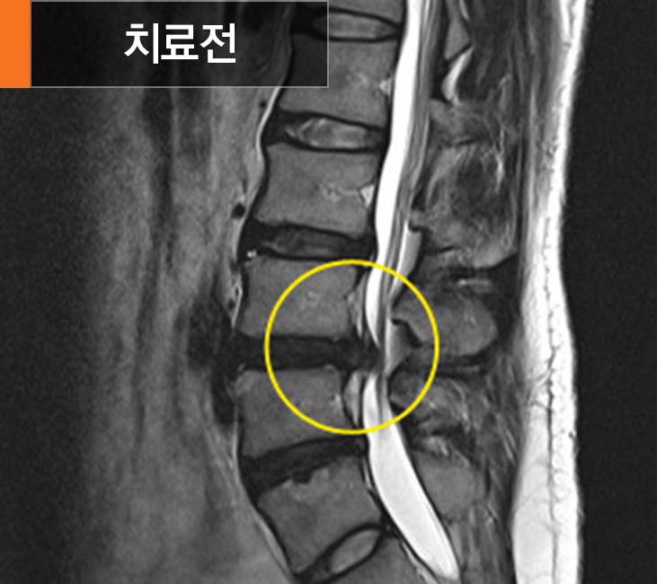 고주파수핵성형술