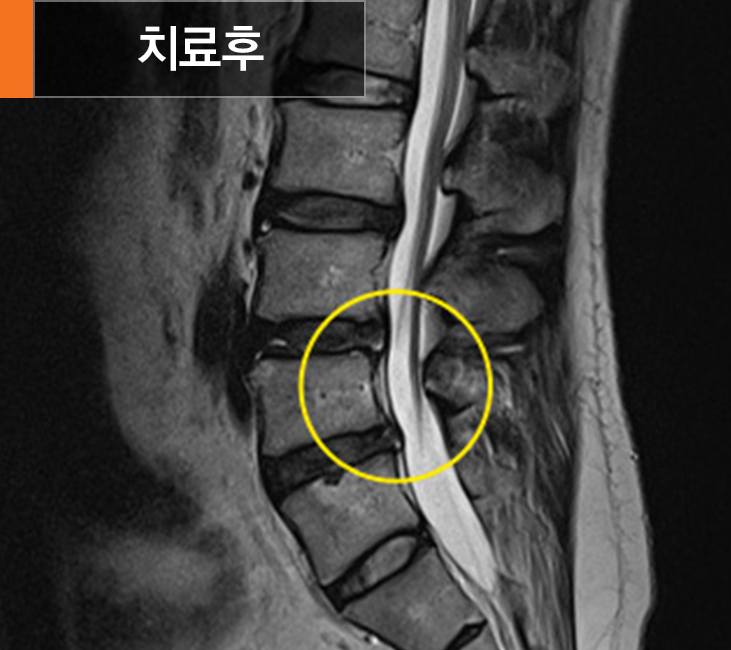 고주파수핵성형술